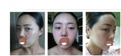在韩国美之爱做V-line+鼻修复+开眼角提肌手术后大变身