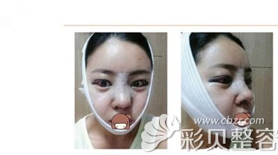 韩国美之爱整形医院做V-line+鼻修复+开眼角提肌手术术后三天
