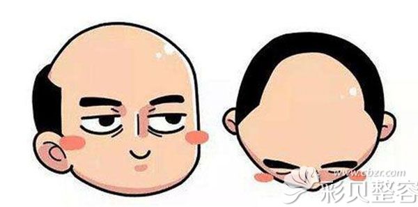 女性脂溢性脱发能植发吗