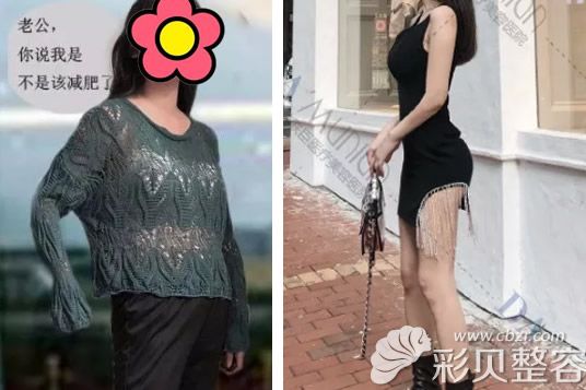 上海美联臣荣峥水动力腰腹吸脂+大腿吸脂前后对比照片