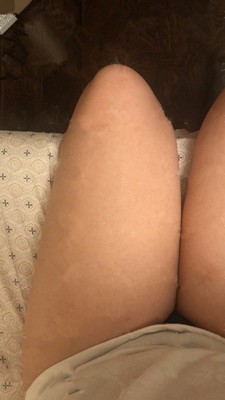 韩国365mc吸脂手术怎么样？看我做大腿吸脂的效果你就知道