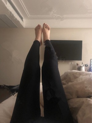 韩国365mc吸脂手术怎么样？看我做大腿吸脂的效果你就知道