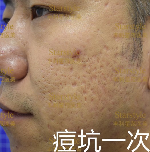 可怕的痘坑痘印和黑眼圈被北京丰科星范吉光宇轻松解决了