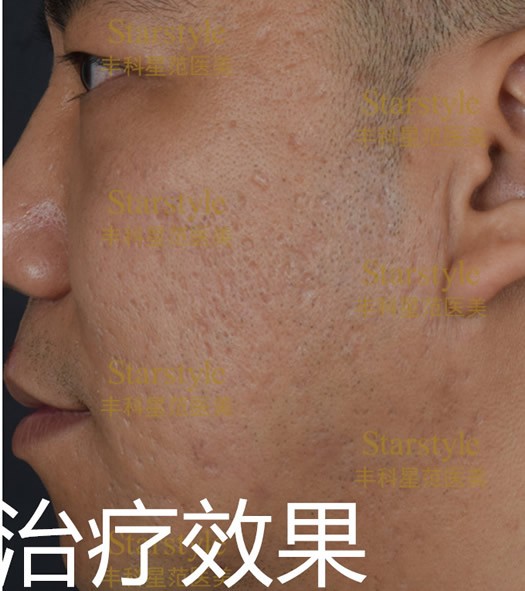 可怕的痘坑痘印和黑眼圈被北京丰科星范吉光宇轻松解决了