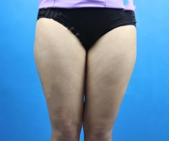 石家庄天伊美张柏松擅长隆胸和吸脂 看他大腿吸脂20天效果