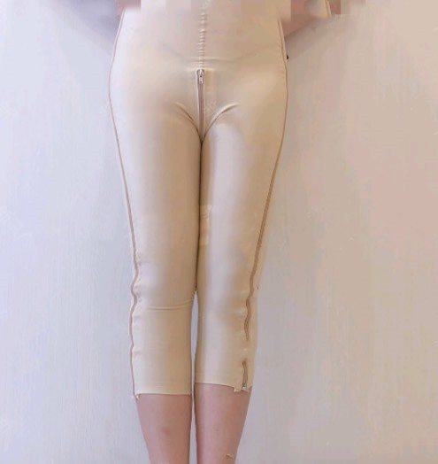 石家庄天伊美张柏松擅长隆胸和吸脂 看他大腿吸脂20天效果