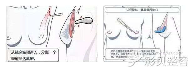 丁庆丰医生分享假体隆胸一般常用的是腋窝切口和乳晕切口