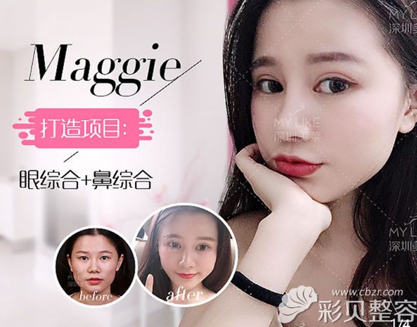 深圳美莱梁志为双眼皮修复+鼻综合隆鼻案例