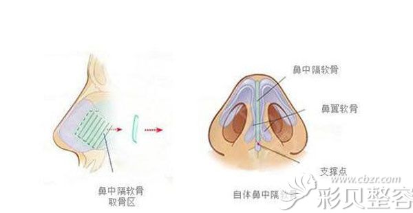 隆鼻失败率高吗