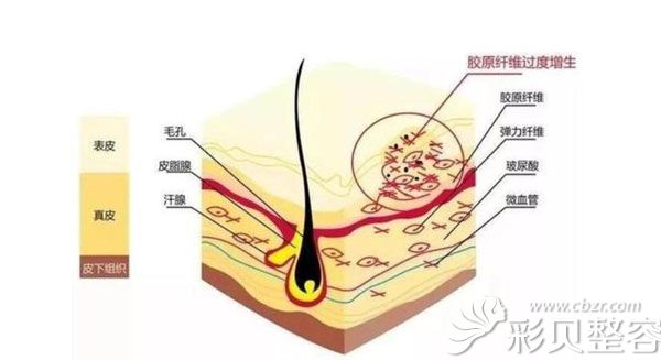 疤痕增生多久可以变平