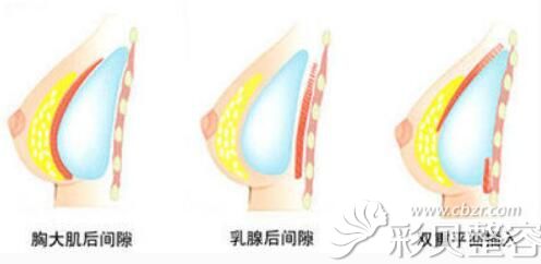 石家庄雅芳亚丁庆丰医生指出，目前隆胸假体可放置位置有三个