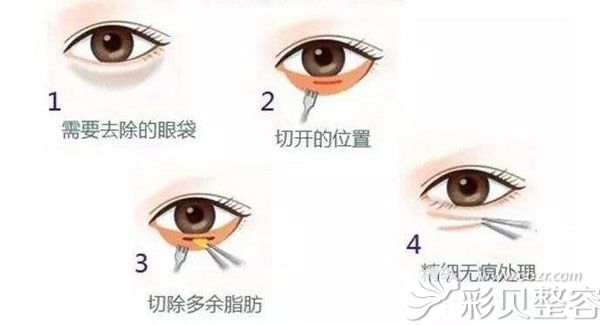 割眼袋会有什么后遗症吗