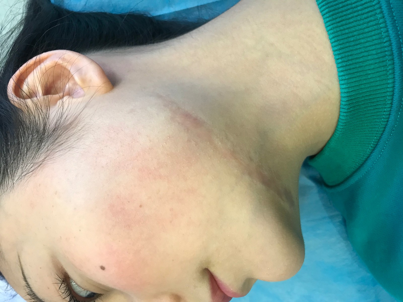 脸上选择激光祛疤来处理 效果很满意