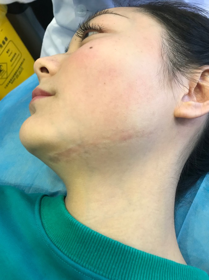 脸上选择激光祛疤来处理 效果很满意