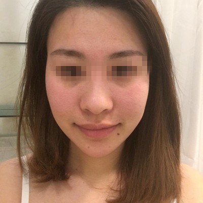 记录我在韩国玛博尔做鼻综合+全脸脂肪填充手术过程