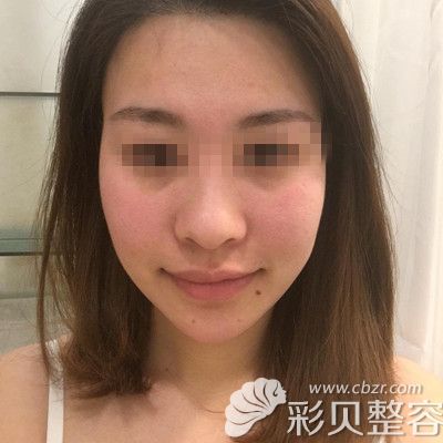 韩国玛博尔做鼻综合+全脸脂肪填充手术术前照