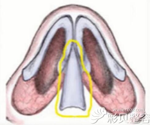 专业的丁庆丰指出鼻中隔软骨隆鼻具有争议性