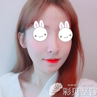 韩国EU颌面轮廓整形外科做双鄂手术术后一个月