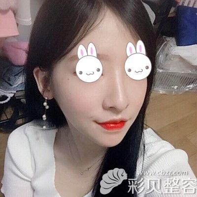 韩国EU颌面轮廓整形外科做双鄂手术术后三个月