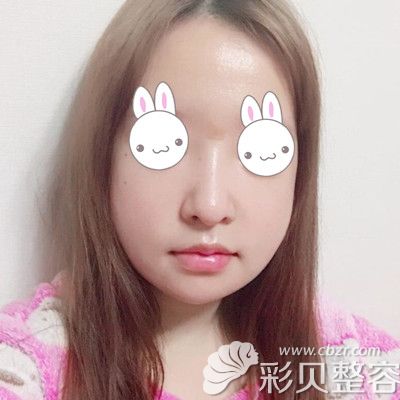 韩国EU颌面轮廓整形外科做双鄂手术术后七天