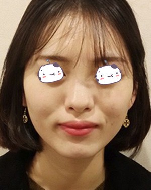 在韩国Star21整形医院做自体脂肪填充全脸恢复全过程
