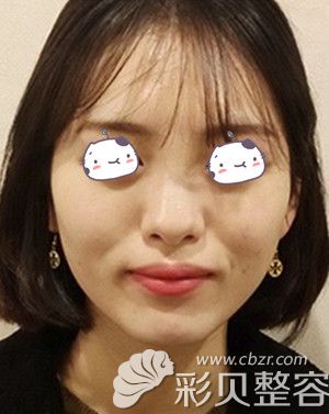 韩国Star21整形医院做自体脂肪填充全脸术前照