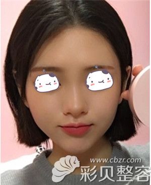 韩国Star21整形医院做自体脂肪填充全脸术后一周