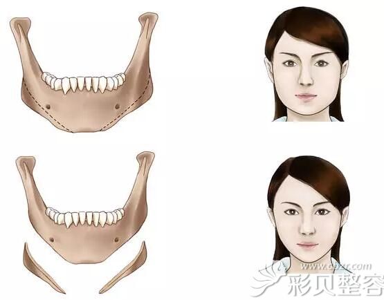 山西整形外科医院刘晋元介绍下颌角整形