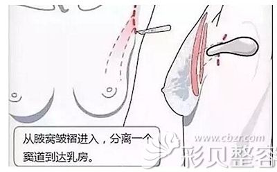 假体隆胸腋下切口的位置