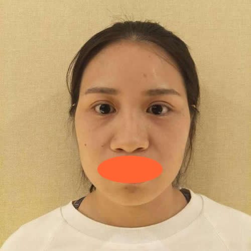 很惊讶找深圳格美黄印资医生做硅胶+肋软骨隆鼻才花了9800元
