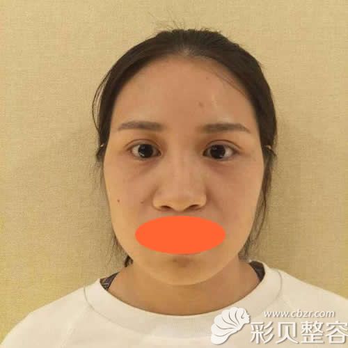 找深圳格美黄印资医生做硅胶+肋软骨隆鼻术前