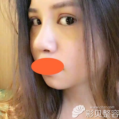 找深圳格美黄印资医生做硅胶+肋软骨隆鼻术后第7天