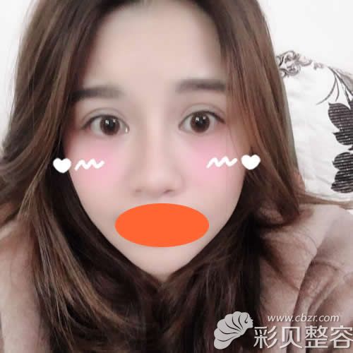 找深圳格美黄印资医生做硅胶+肋软骨隆鼻术后第35天