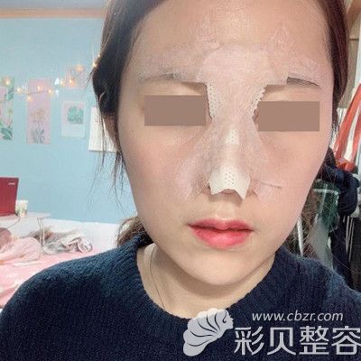 韩国POP整形医院做鼻综合手术术后当天