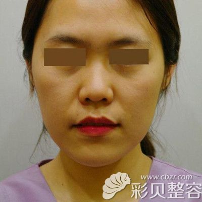 韩国POP整形医院做鼻综合手术术前照