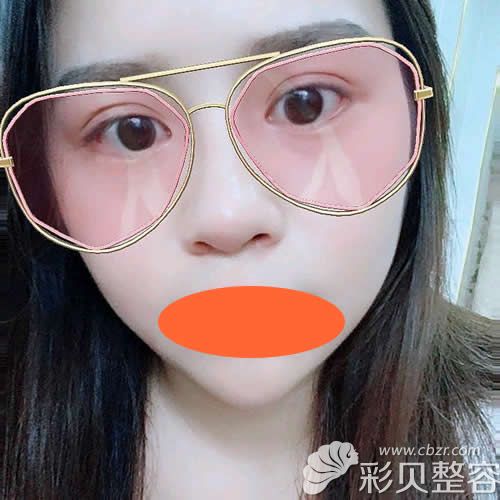 找深圳格美黄印资医生做硅胶+肋软骨隆鼻术后第18天
