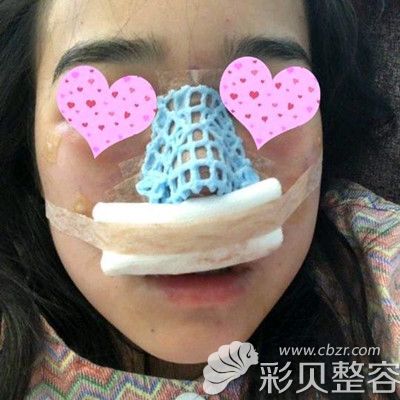 韩国GNG做肋软骨隆鼻术后当天