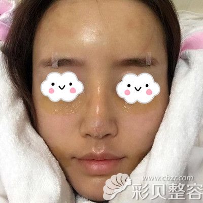 韩国芭堂做埋线提升术后当天