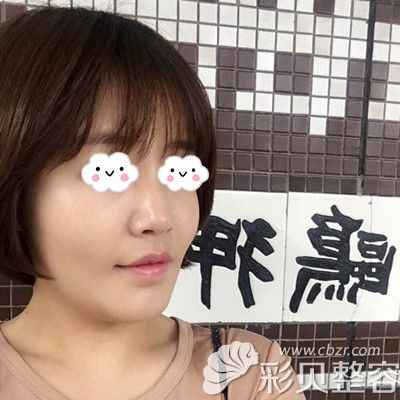 韩国芭堂做埋线提升术后一个月