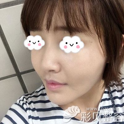 韩国芭堂做埋线提升术后十天