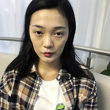 29岁的她,到常德做了自体脂肪面部填充后,瞬间年轻10岁！