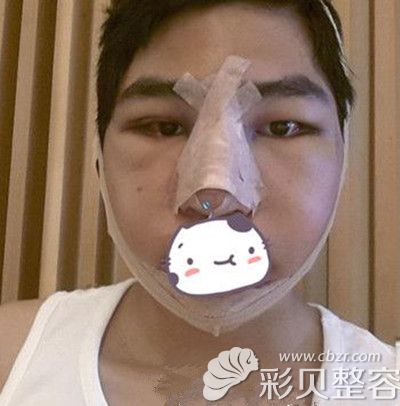 韩国JJ洪镇柱做面部轮廓+眼鼻整形手术术后当天