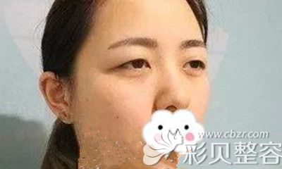 韩国摩兹MODS做双眼皮手术术前照