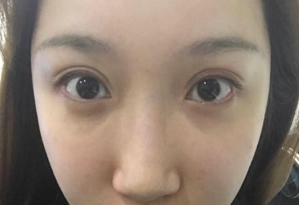 亲身经历后才知道大连爱德丽格整形刘志刚修复眼睛有多好