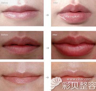 嘴角上扬术前后对比图