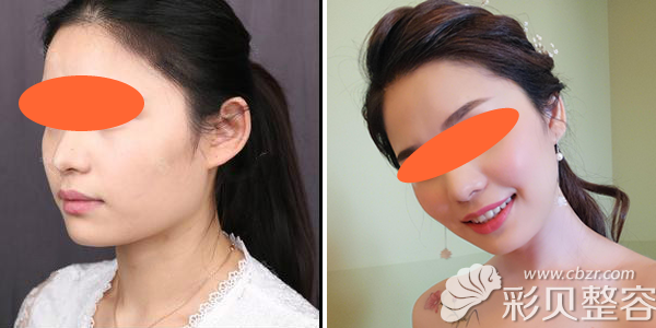 上海华美医院李志海下颌角整形真人<span style=