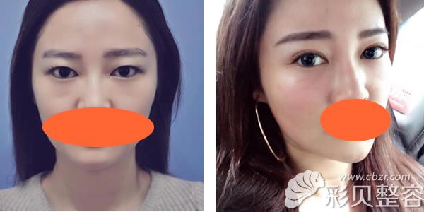 赵越切开双眼皮+开眼角真实<span style=