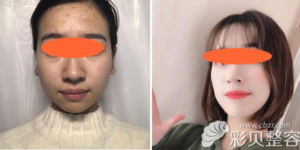 西安高一生金磊肋骨隆鼻真人<span style=