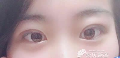 去广州高尚医学美容中心找余文林院长割双眼皮术后第18天