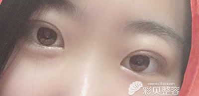 去广州高尚医学美容中心找余文林院长割双眼皮术后一个月